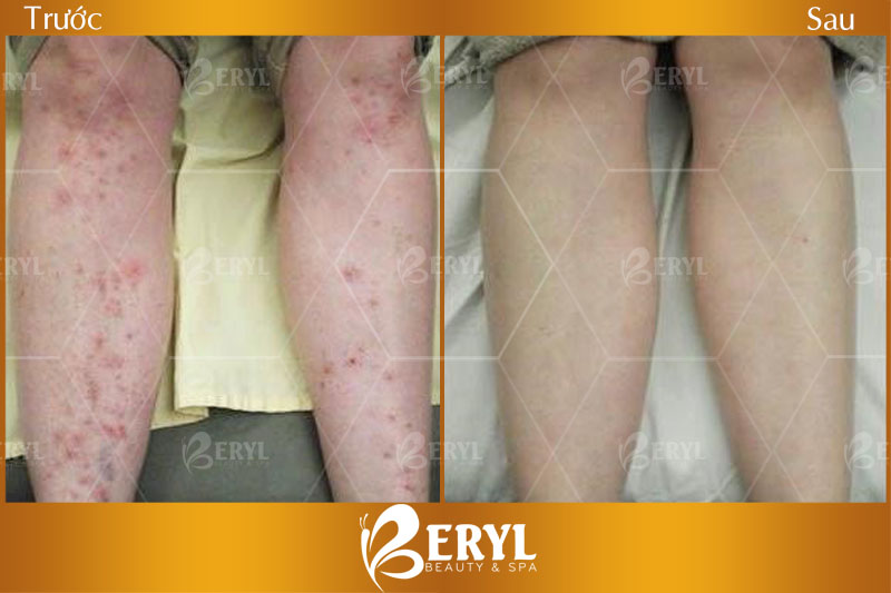 Hình ảnh trước và sau khi trị sẹo thâm chân tại Beryl Beauty & Spa