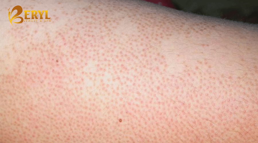Biểu hiện của bệnh viêm nang lông