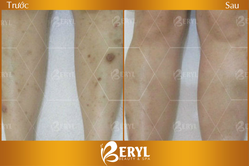 Điều trị sẹo thâm chân tại Beryl Beauty & Spa Điều trị sẹo thâm chân tại Beryl Beauty & Spa