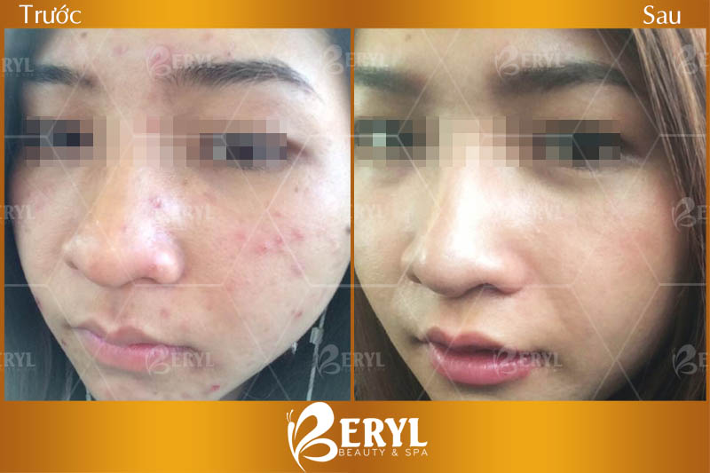Hình ảnh trước và sau khi điều trị mụn tại Beryl Beauty & Spa