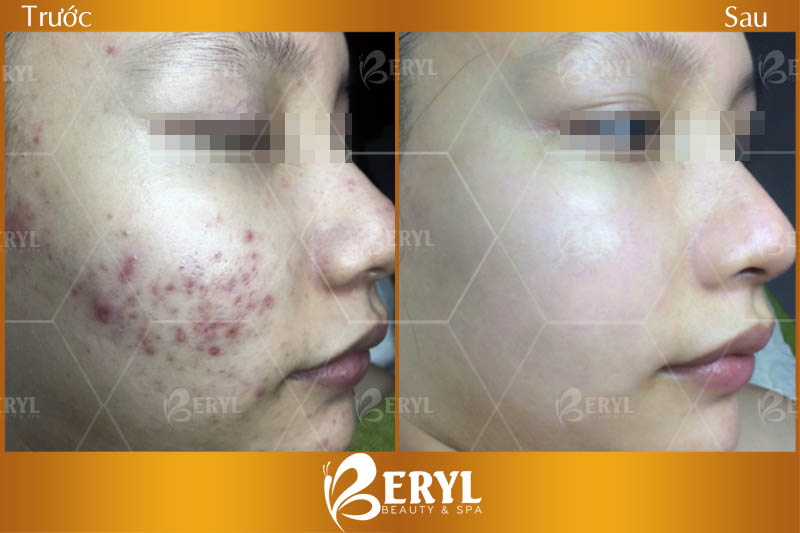 Trước và sau khi khách hàng điều trị mụn tại Beryl Beauty & Spa