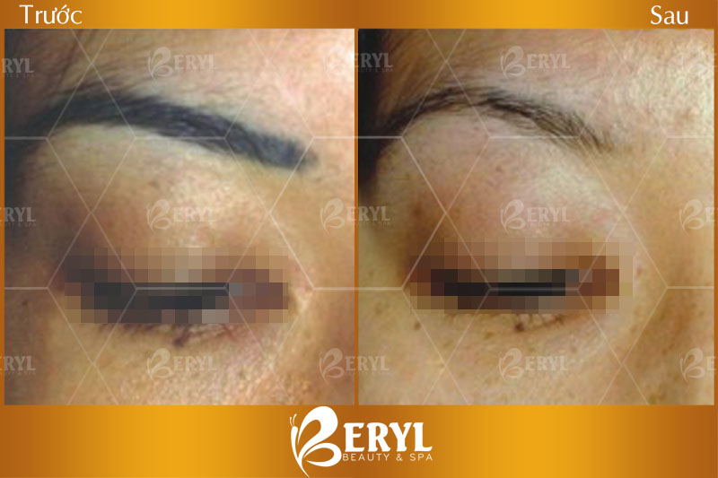 Trước và sau khi xóa lông mày tại Beryl Beauty & Spa