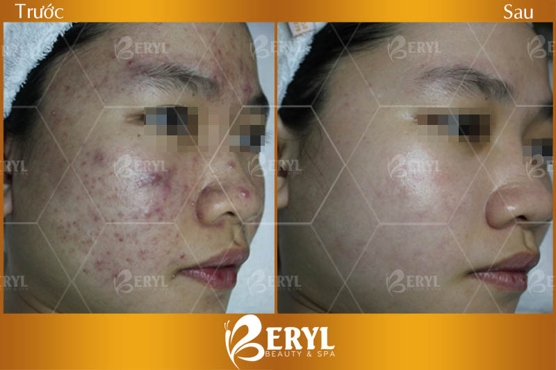 Tham khảo hình ảnh trước và sau khi điều trị mụn bằng ánh sáng sinh học tại Beryl Beauty & Spa